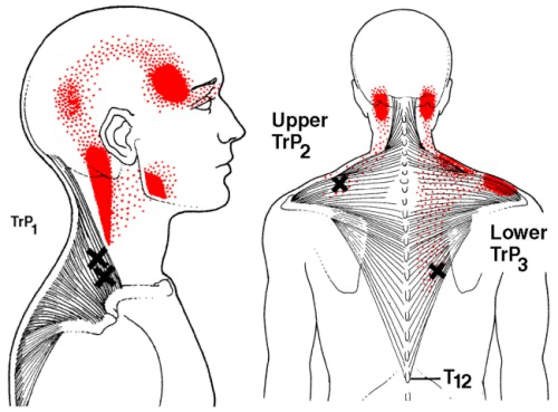 Trapecinio raumens įtampos sukelto skausmo galima lokalizacija 