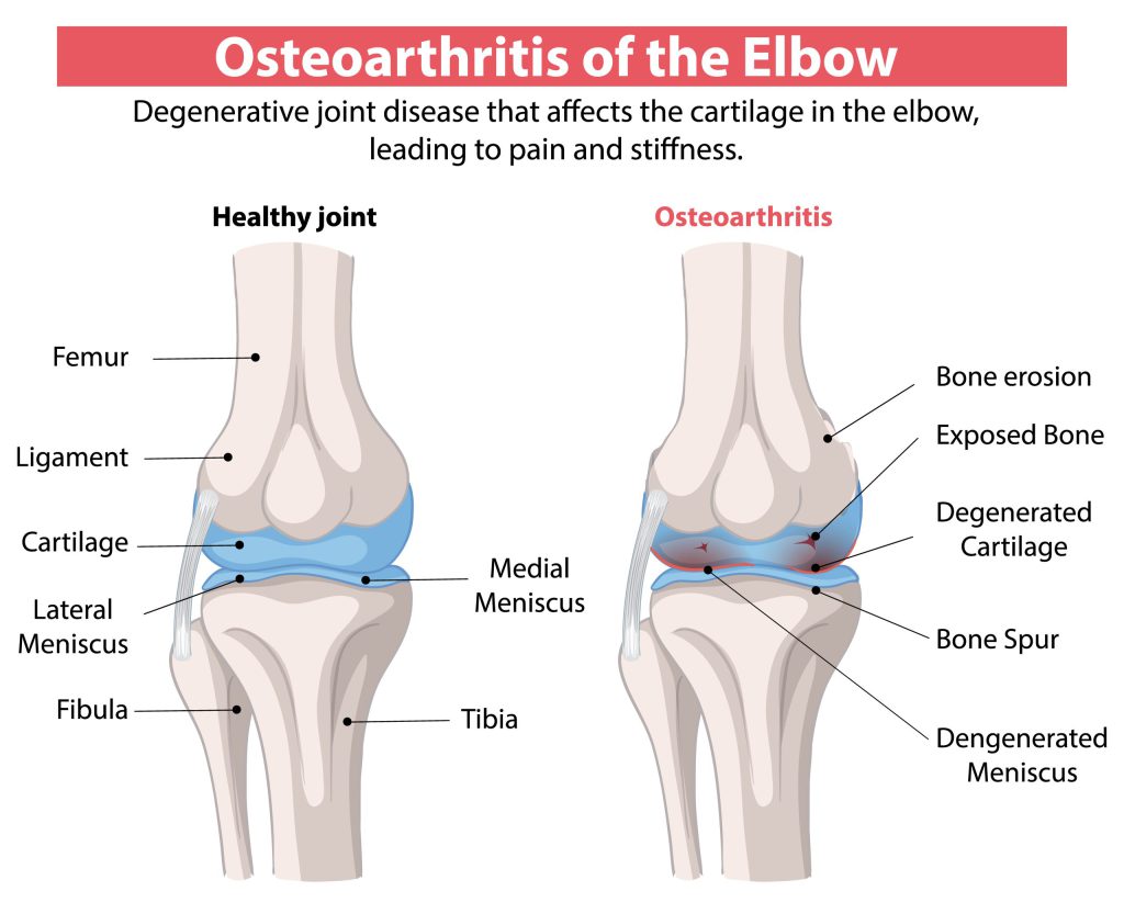 Osteoartritas