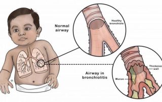 Bronchiolitas