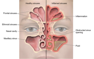 Sinusitas
