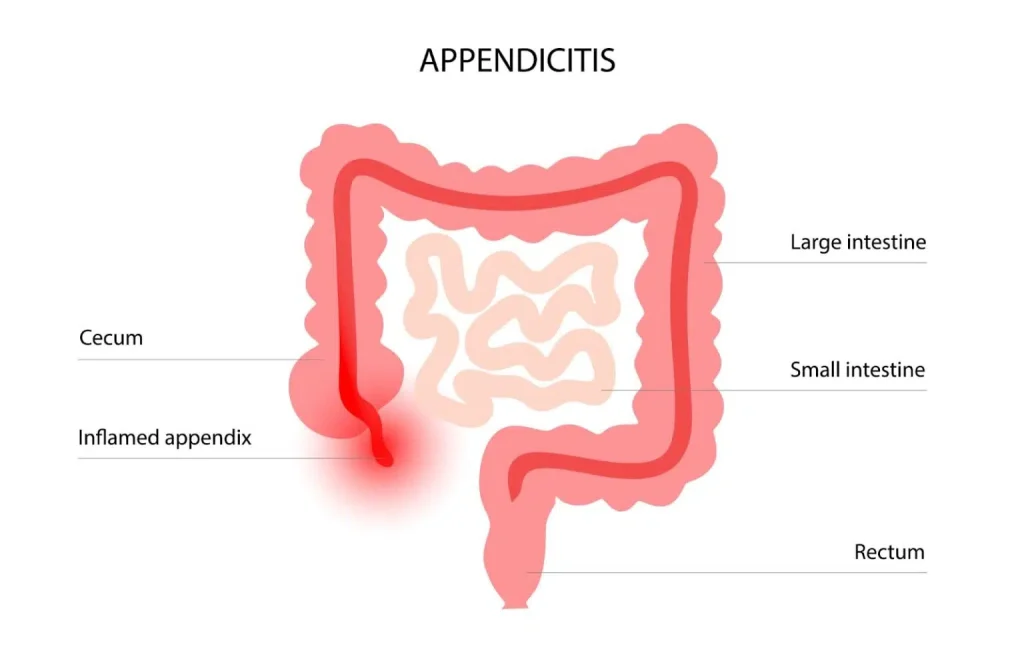apendicitas