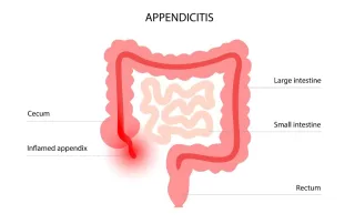apendicitas