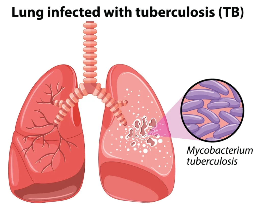Tuberkuliozė