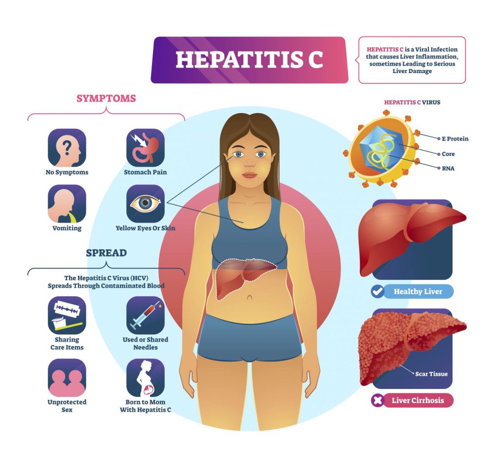 Hepatitas C