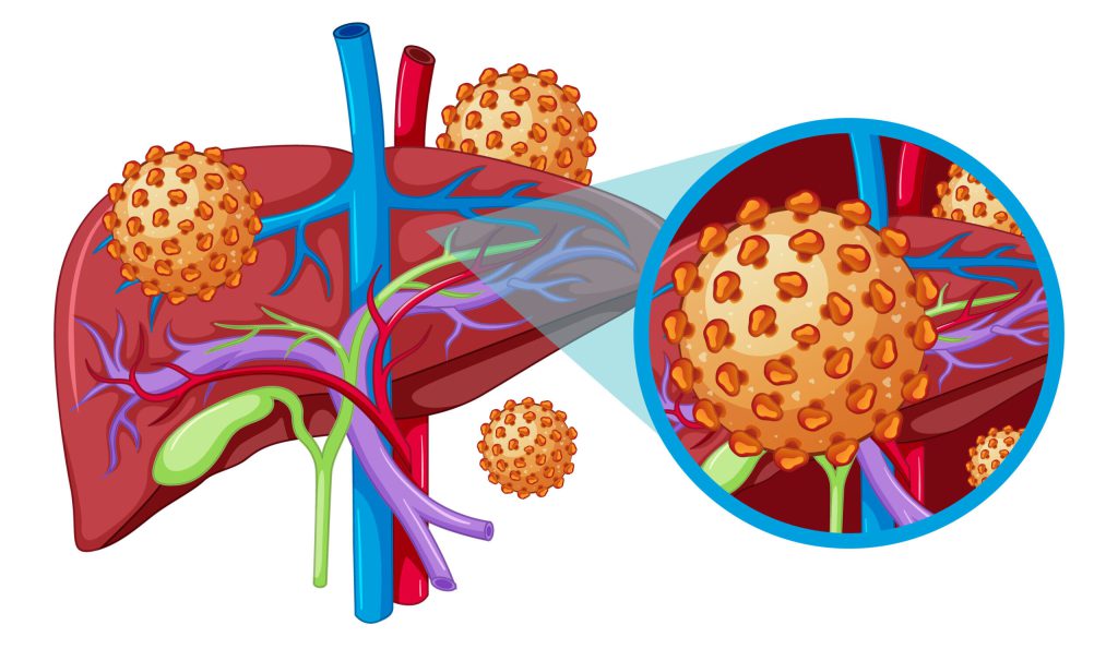 Hepatitas A