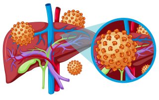 Hepatitas A