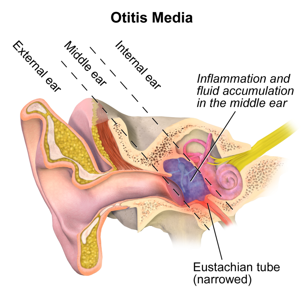 Otitas