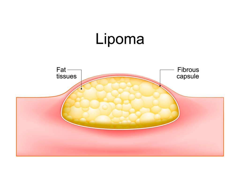 Lipoma
