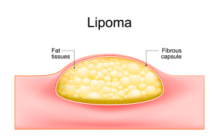 Lipoma