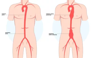 Pilvo aortos aneurizma