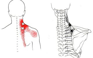 Keliamojo mentės raumens sindromas