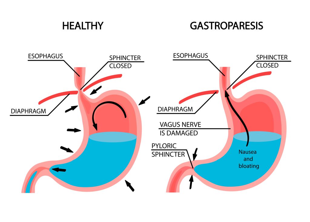Gastroparezė