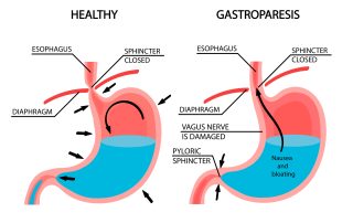 Gastroparezė
