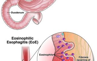 Ezofagitas