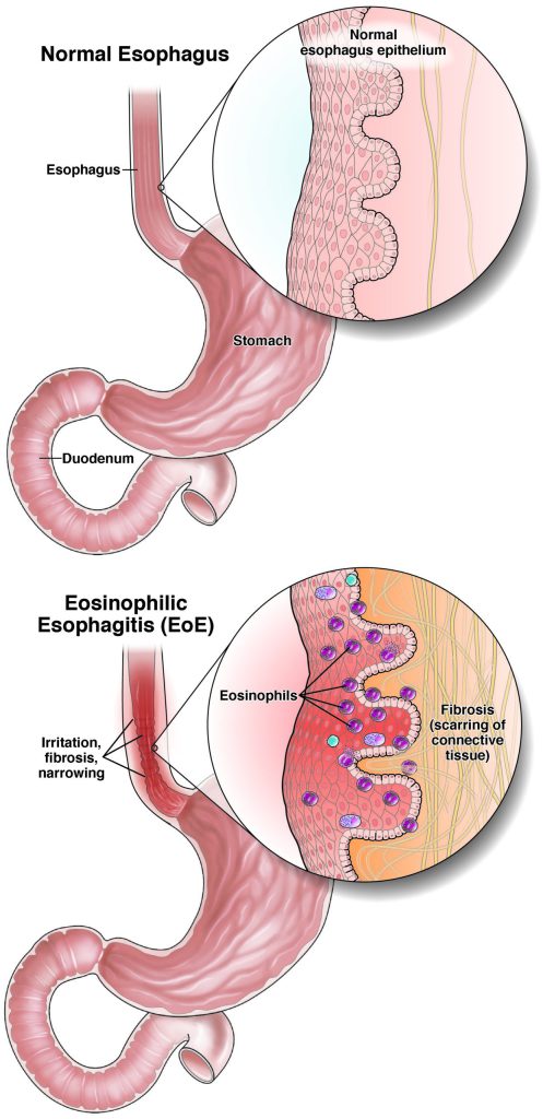 Ezofagitas