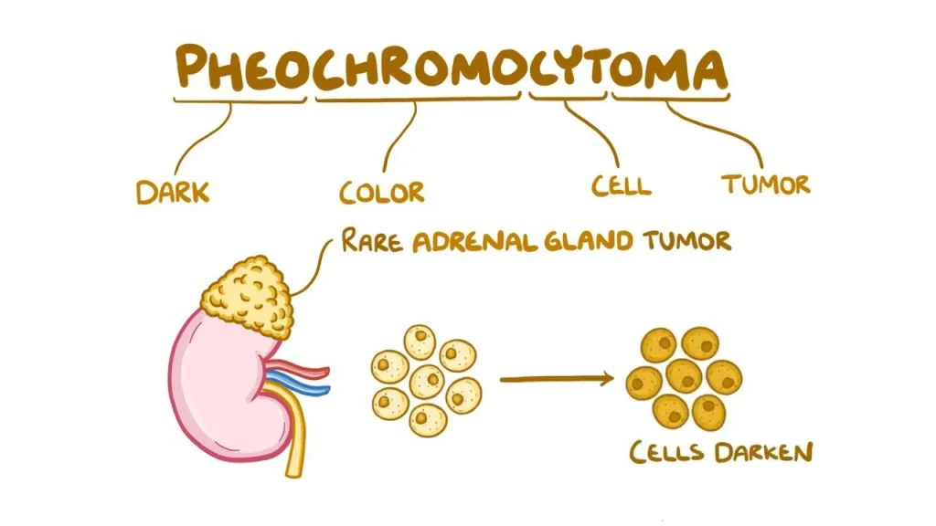 Feochromocitoma