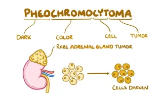 Feochromocitoma