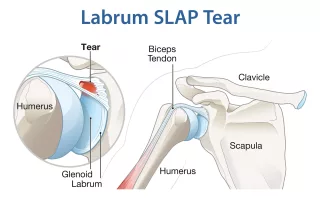 SLAP pažeidimas