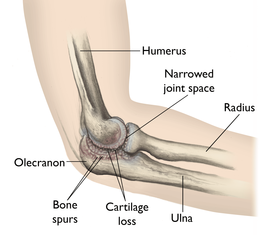 Alkūnės osteoartritas