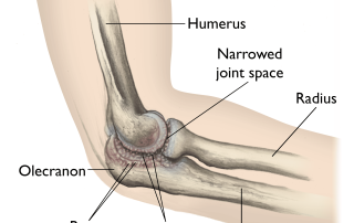 Alkūnės osteoartritas