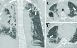 Plaučių uždegimas