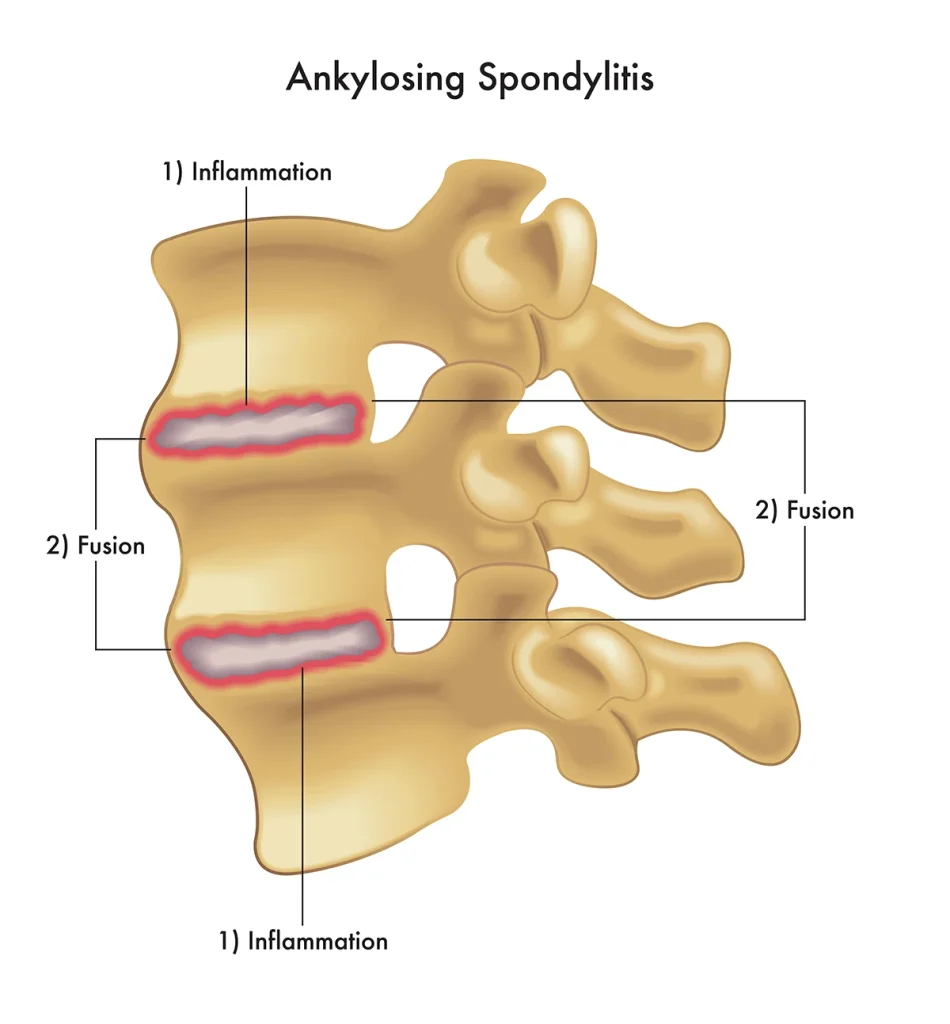 Ankilozinis spondilitas