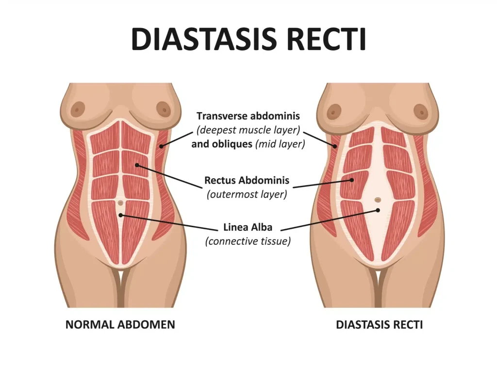 Tiesiojo pilvo raumens diastazė