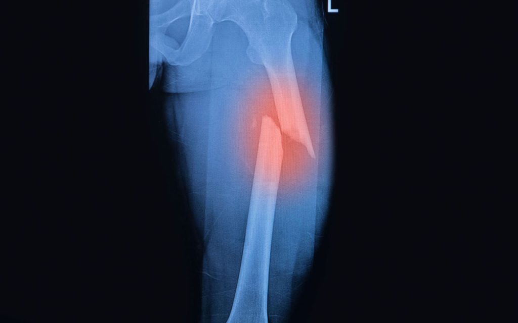 Šlaunikaulio lūžis