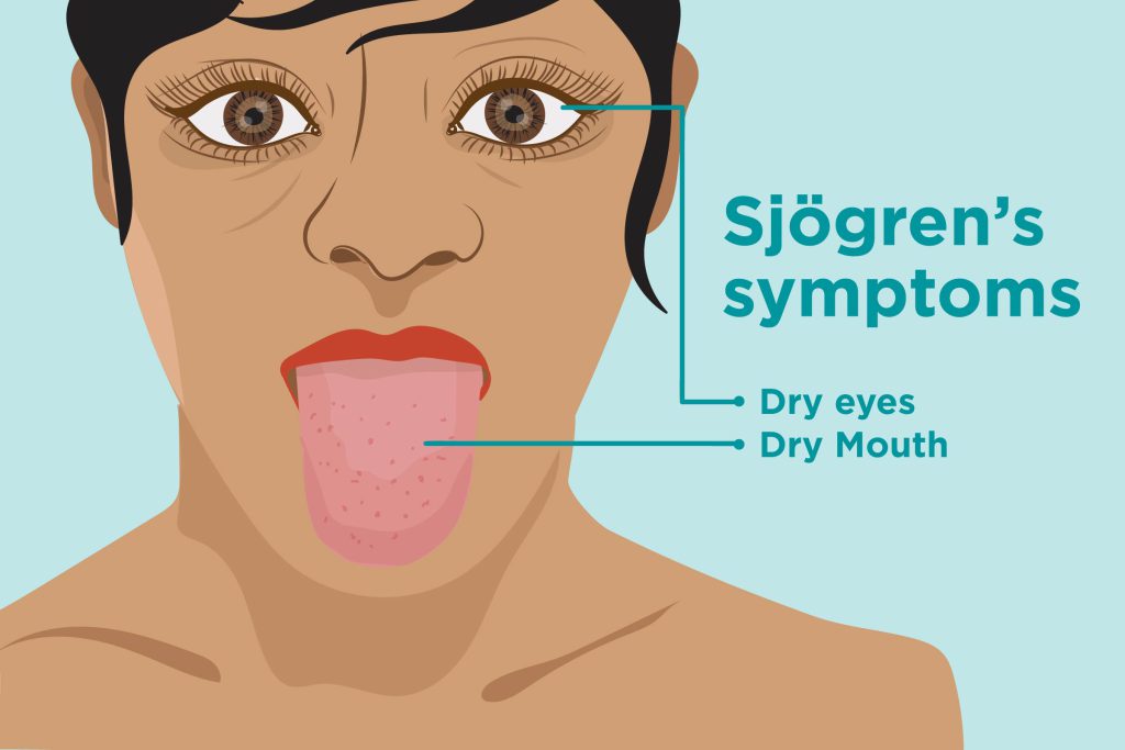 Sjogreno sindromas
