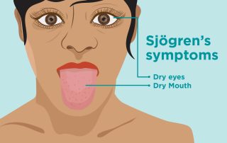 Sjogreno sindromas