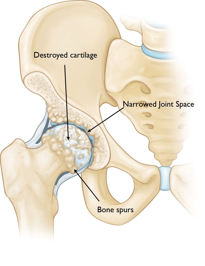 Klubo osteoartritas
