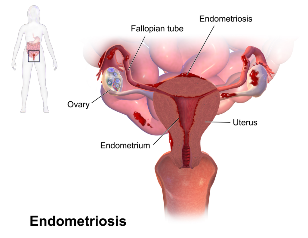 Endometriozė