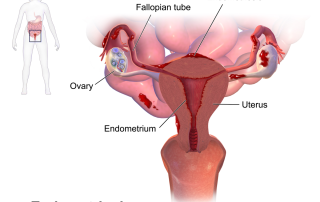 Endometriozė