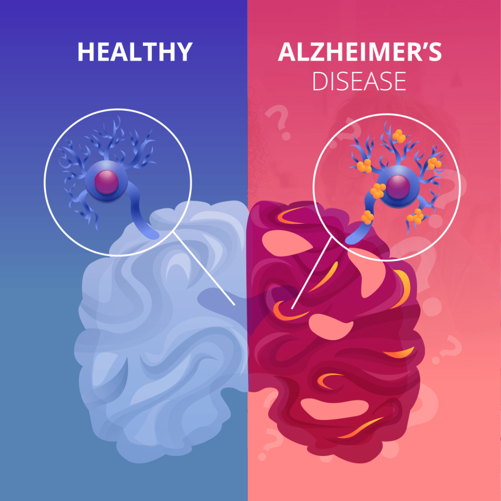Alzheimerio liga