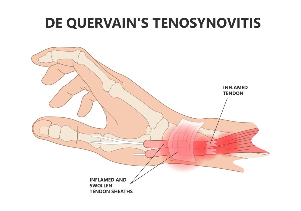 De qvarten tenosinovijitas
