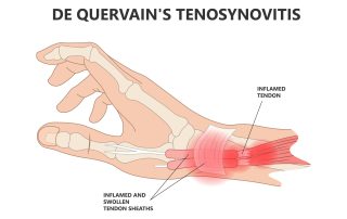 De qvarten tenosinovijitas