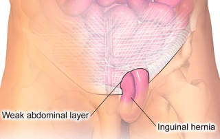 Kirkšnies išvarža