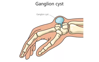 Gangliono cista