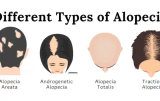 Alopecija