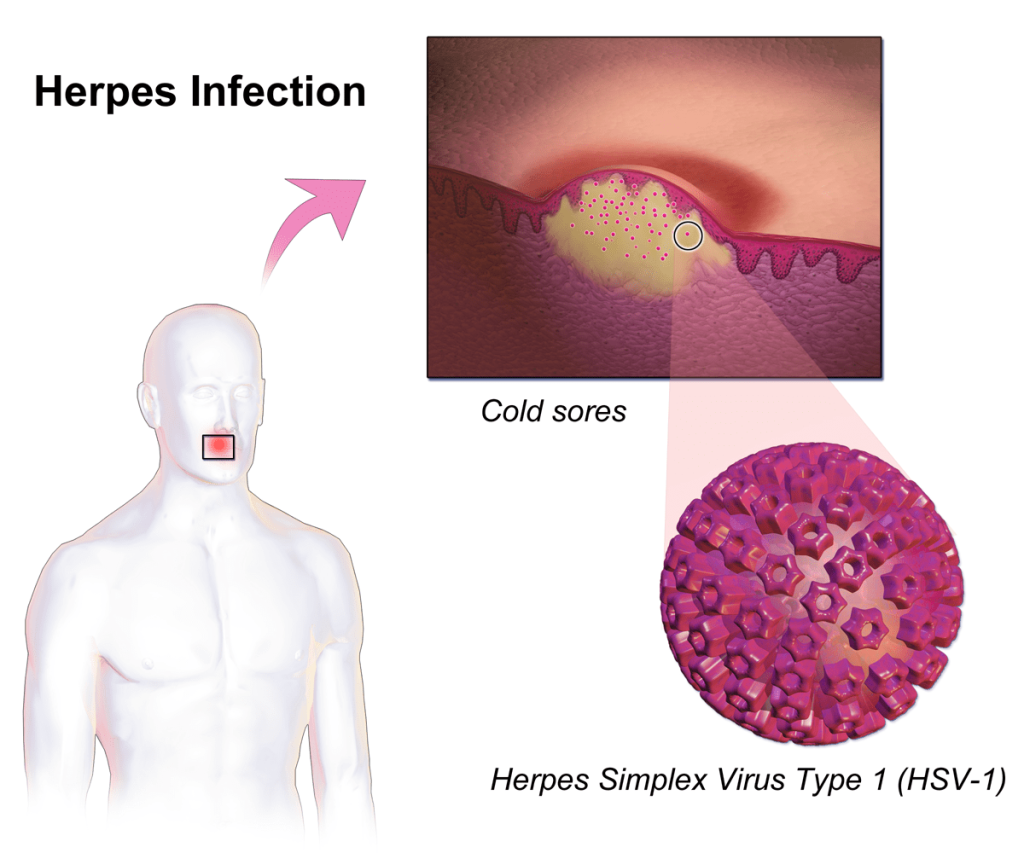 Herpes virusinė infekcija