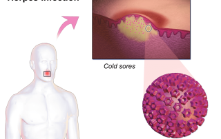 Herpes virusinė infekcija