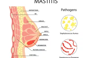 Mastitas