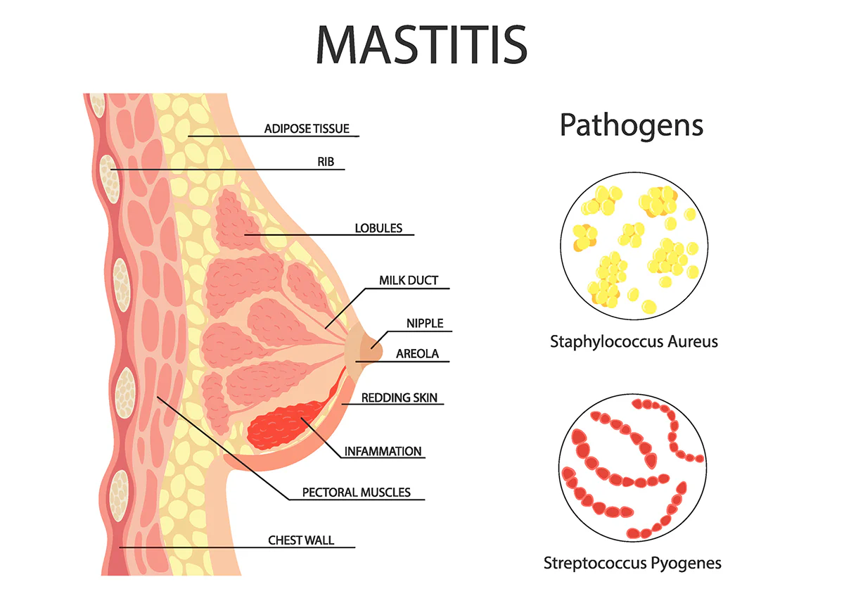 Mastitas