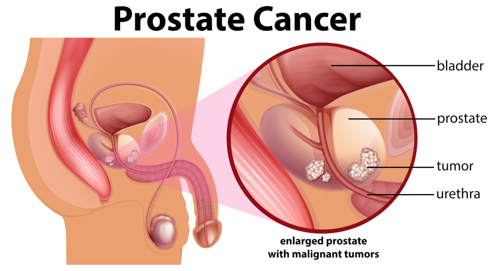Prostatos vėžys