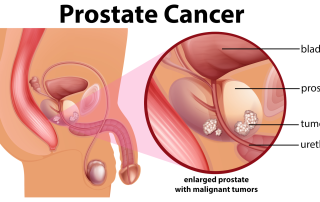 Prostatos vėžys