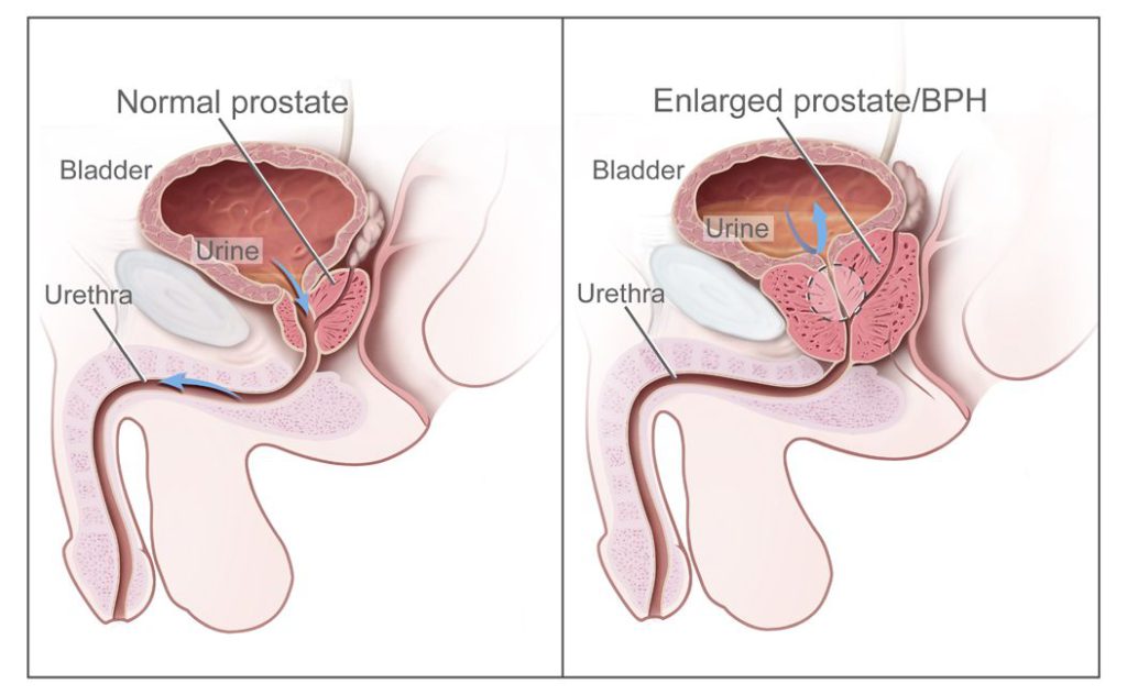 Prostatos hiperplazija