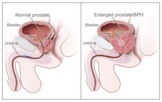 Prostatos hiperplazija