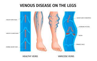 Venų varikozė