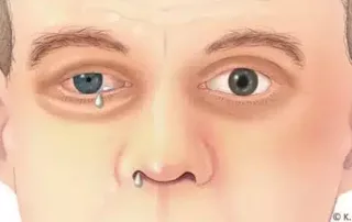 Paroksizminė hemikranija