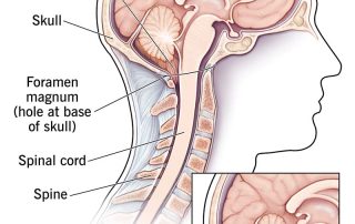 Chiari Malformacija